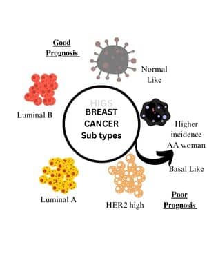 Breast-cancer-subtypes